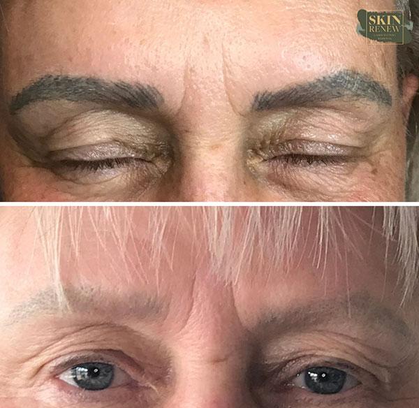 Skin Renew Day Spa & Laser Center laser treatment result — Indianapolis, IN