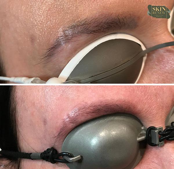 Laser Skin Resurfacing result at Skin Renew Day Spa & Laser Center in Indianapolis, IN