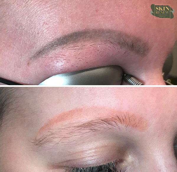 Skin Renew Day Spa & Laser Center result — Indianapolis, IN