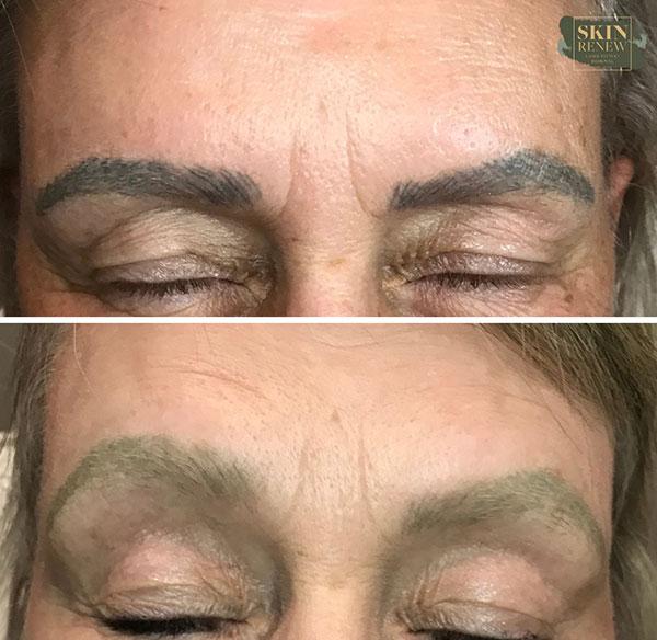 Skin Renew Day Spa & Laser Center laser treatment result — Indianapolis, IN