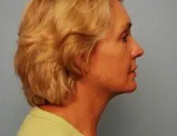 PREMIERE Center for Cosmetic Surgery Tampa after — Tampa, FL