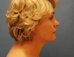 Facelift before at PREMIERE Center for Cosmetic Surgery Tampa in Tampa, FL