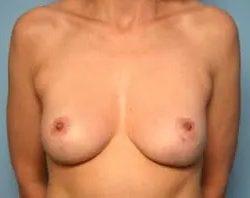Breast Lift after at PREMIERE Center for Cosmetic Surgery Tampa in Tampa, FL