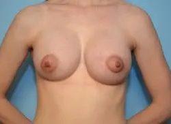 Breast Augmentation after at PREMIERE Center for Cosmetic Surgery Tampa in Tampa, FL