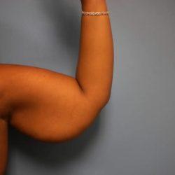 Arm Lift before at PREMIERE Center for Cosmetic Surgery Tampa in Tampa, FL