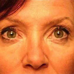 PREMIERE Center for Cosmetic Surgery Tampa after — Tampa, FL