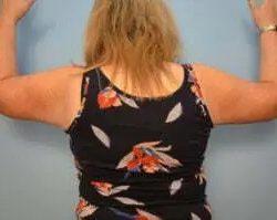 Arm Lift after at PREMIERE Center for Cosmetic Surgery Tampa in Tampa, FL