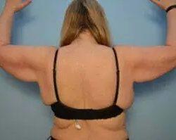 Arm Lift before at PREMIERE Center for Cosmetic Surgery Tampa in Tampa, FL