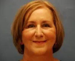PREMIERE Center for Cosmetic Surgery Tampa facelift after — Tampa, FL