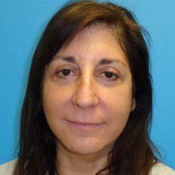 Blepharoplasty after at PREMIERE Center for Cosmetic Surgery Tampa in Tampa, FL