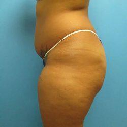 Brazilian Butt Lift before at PREMIERE Center for Cosmetic Surgery Tampa in Tampa, FL