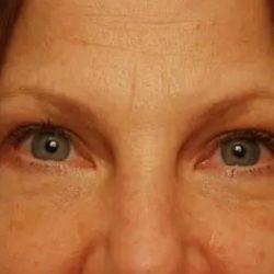 PREMIERE Center for Cosmetic Surgery Tampa after — Tampa, FL