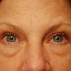 Blepharoplasty before at PREMIERE Center for Cosmetic Surgery Tampa in Tampa, FL