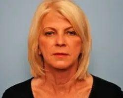 Facelift after at PREMIERE Center for Cosmetic Surgery Tampa in Tampa, FL