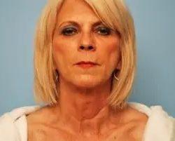 Facelift before at PREMIERE Center for Cosmetic Surgery Tampa in Tampa, FL