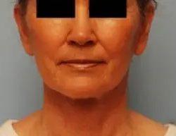 PREMIERE Center for Cosmetic Surgery Tampa after — Tampa, FL