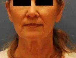 Facelift before at PREMIERE Center for Cosmetic Surgery Tampa in Tampa, FL