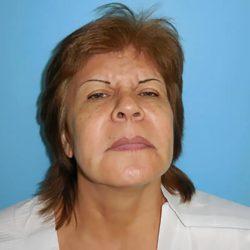 Facelift before at PREMIERE Center for Cosmetic Surgery Tampa in Tampa, FL
