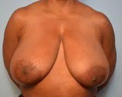 Breast Reduction before at PREMIERE Center for Cosmetic Surgery Tampa in Tampa, FL