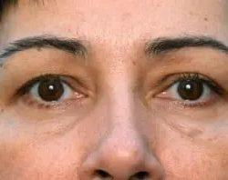 PREMIERE Center for Cosmetic Surgery Tampa after — Tampa, FL