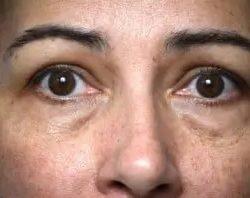 Blepharoplasty before at PREMIERE Center for Cosmetic Surgery Tampa in Tampa, FL