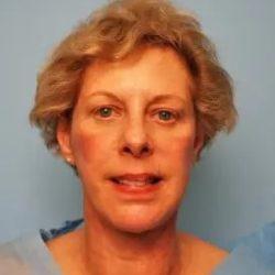 Facelift after at PREMIERE Center for Cosmetic Surgery Tampa in Tampa, FL