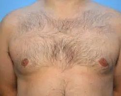 Gynecomastia Surgery after at PREMIERE Center for Cosmetic Surgery Tampa in Tampa, FL