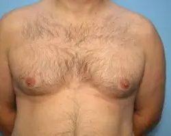 Gynecomastia Surgery before at PREMIERE Center for Cosmetic Surgery Tampa in Tampa, FL