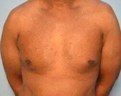 Gynecomastia Surgery after at PREMIERE Center for Cosmetic Surgery Tampa in Tampa, FL