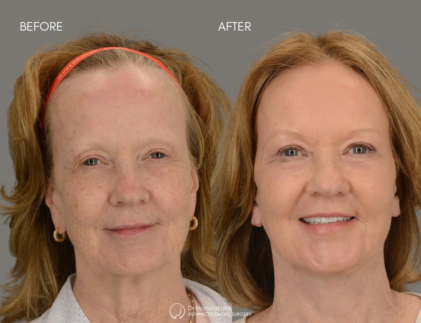 Advanced Facial Surgery (Manolis Manolakakis, DMD) facelift result — New York, NY