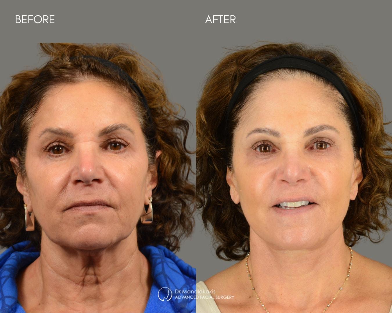 Advanced Facial Surgery (Manolis Manolakakis, DMD) facelift result — New York, NY