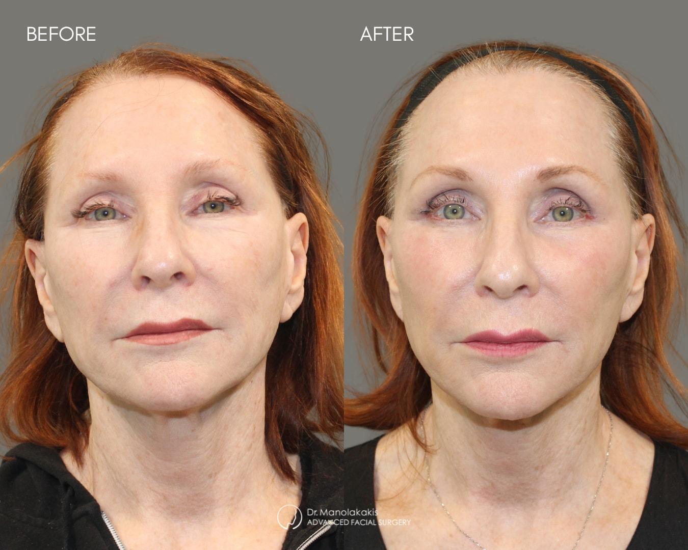 Advanced Facial Surgery (Manolis Manolakakis, DMD) eyelid lift result — New York, NY