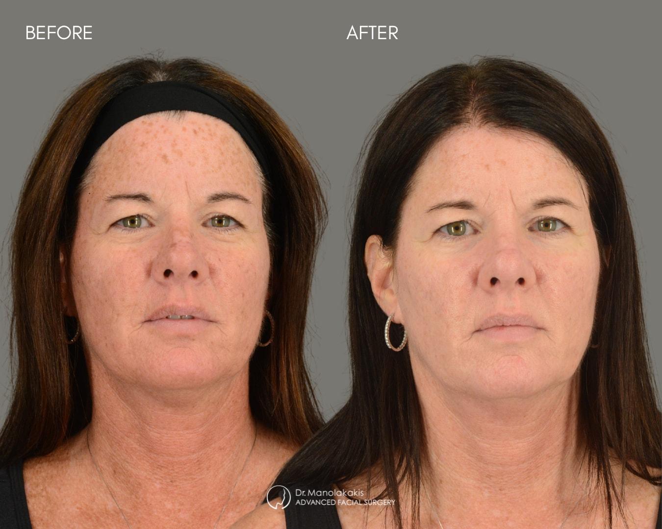Advanced Facial Surgery (Manolis Manolakakis, DMD) laser treatment result — New York, NY