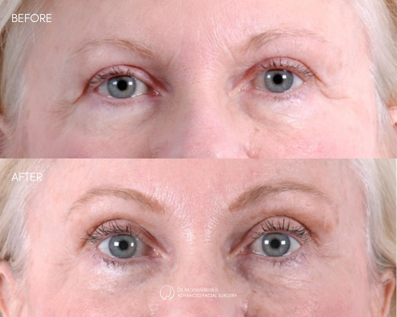 Advanced Facial Surgery (Manolis Manolakakis, DMD) brow lift result — New York, NY