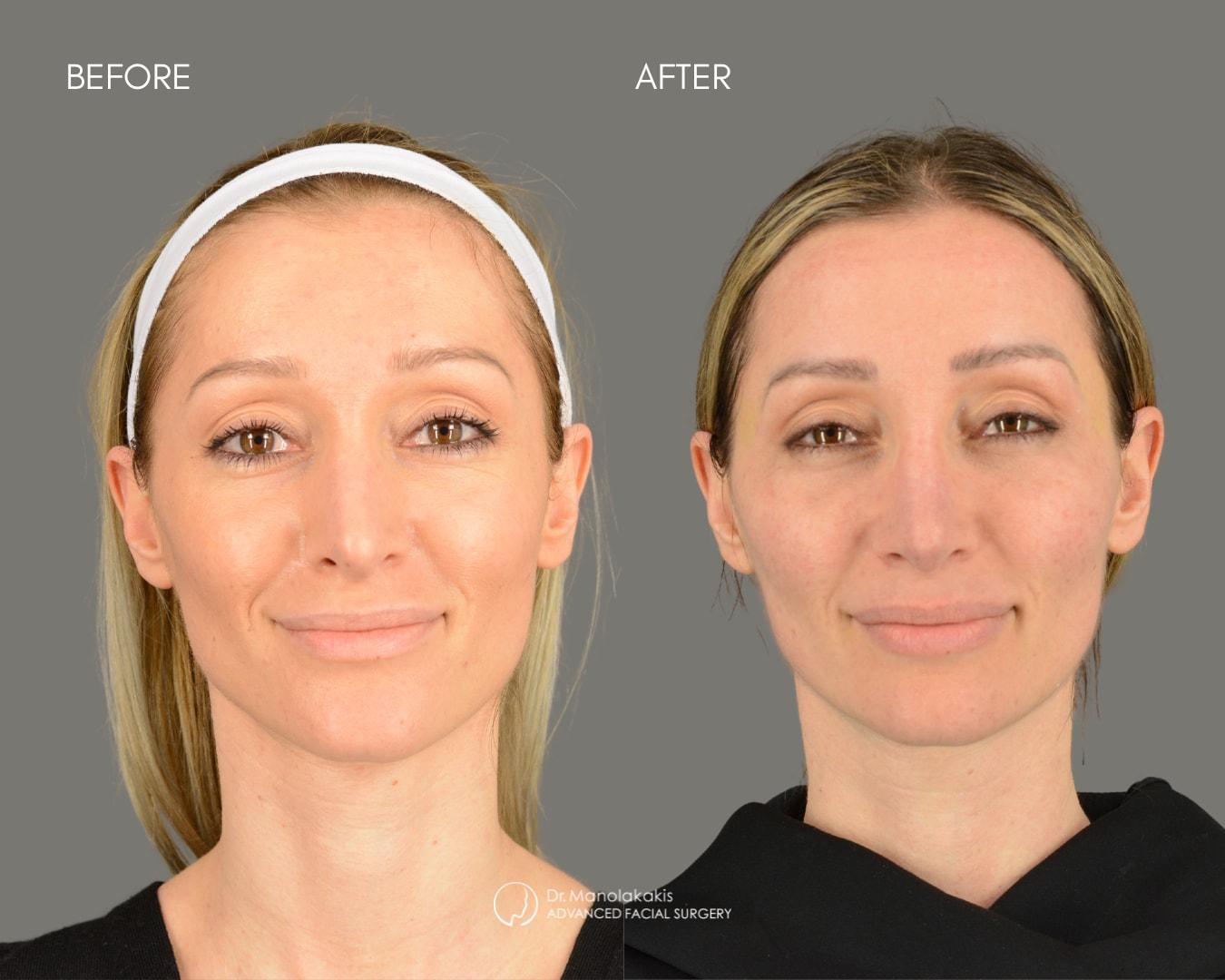 Advanced Facial Surgery (Manolis Manolakakis, DMD) eyelid lift result — New York, NY