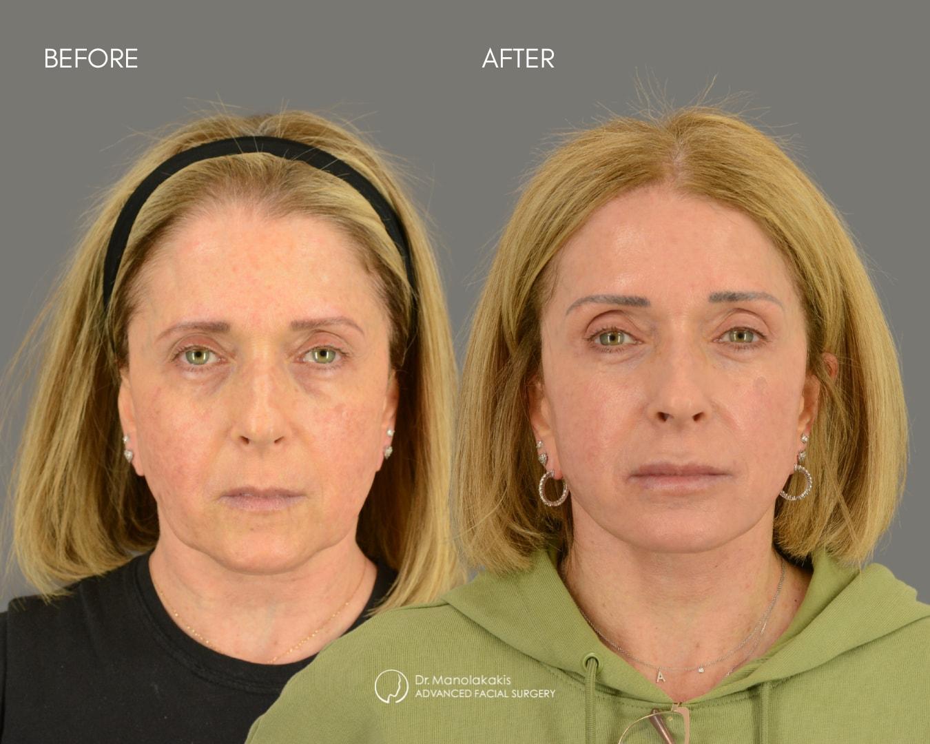 Advanced Facial Surgery (Manolis Manolakakis, DMD) facelift result — New York, NY