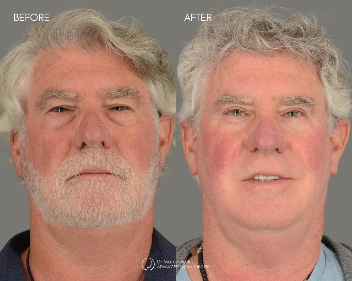 Advanced Facial Surgery (Manolis Manolakakis, DMD) eyelid lift result — New York, NY