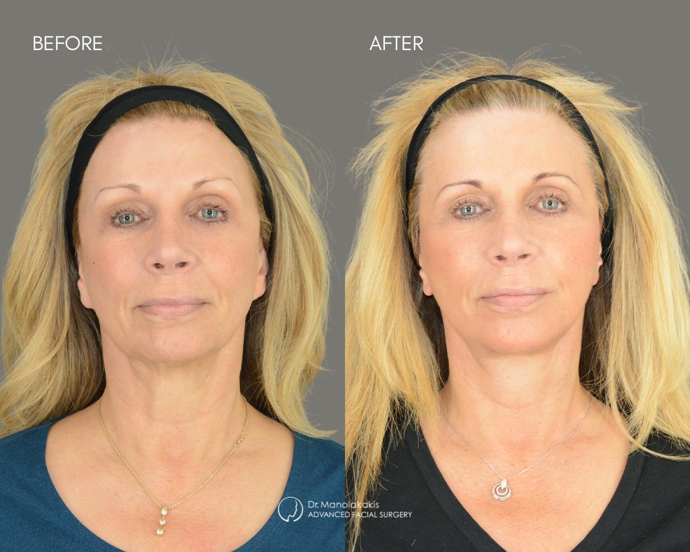 Advanced Facial Surgery (Manolis Manolakakis, DMD) facelift result — New York, NY