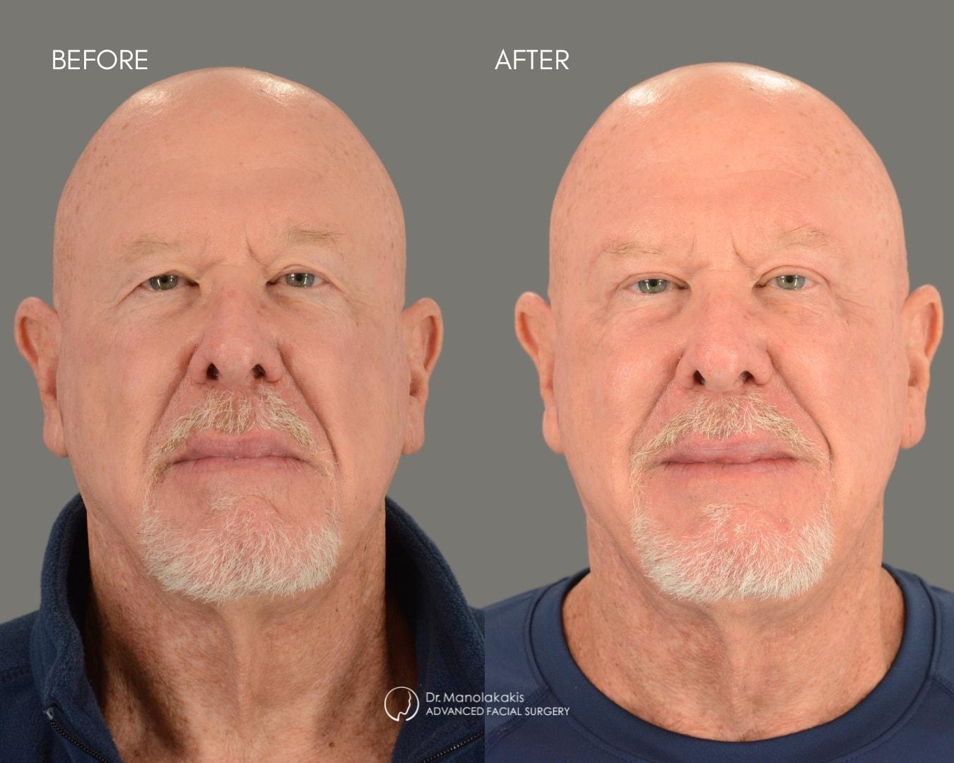 Advanced Facial Surgery (Manolis Manolakakis, DMD) brow lift result — New York, NY