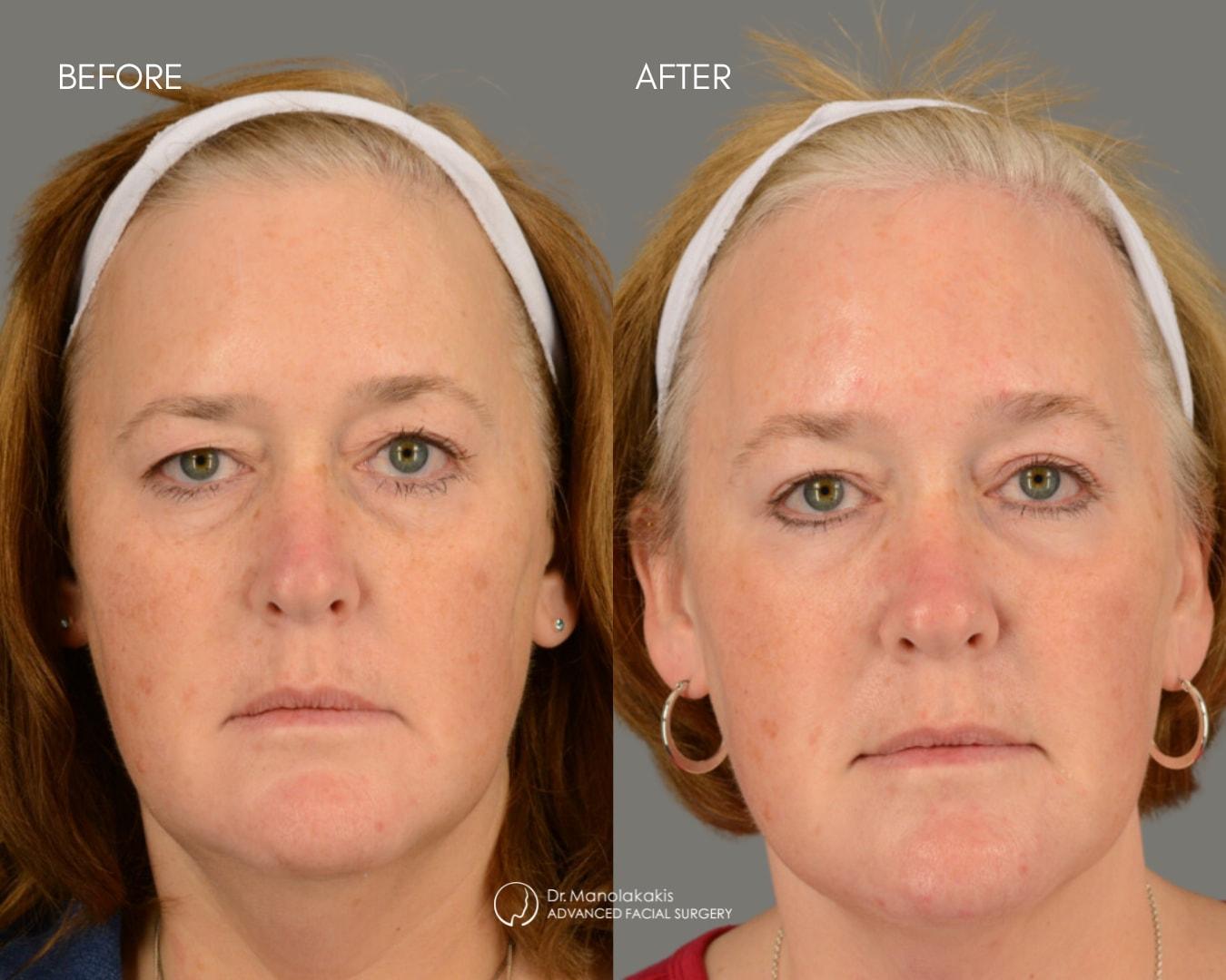 Advanced Facial Surgery (Manolis Manolakakis, DMD) eyelid lift result — New York, NY