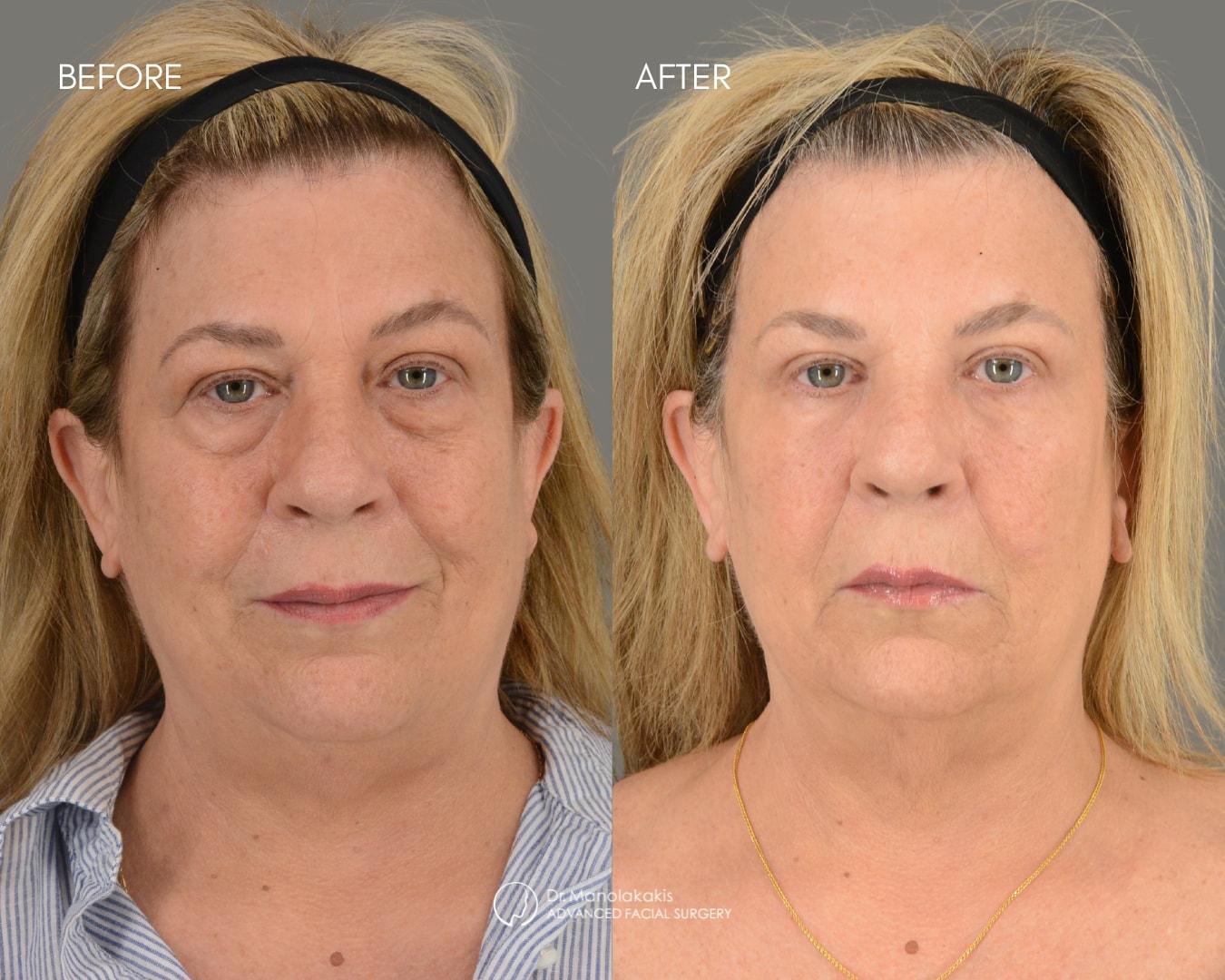 Advanced Facial Surgery (Manolis Manolakakis, DMD) eyelid lift result — New York, NY
