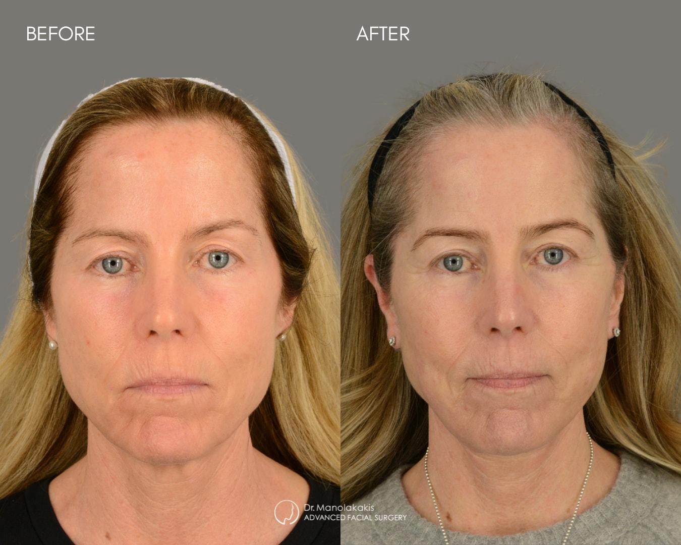 Advanced Facial Surgery (Manolis Manolakakis, DMD) facelift result — New York, NY