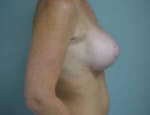 John F. Farella, MD, FACS breast lift after — White Plains, NY