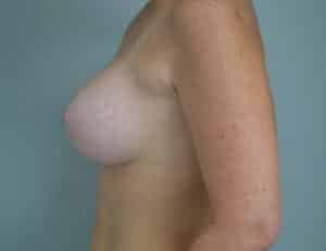 John F. Farella, MD, FACS breast lift after — White Plains, NY