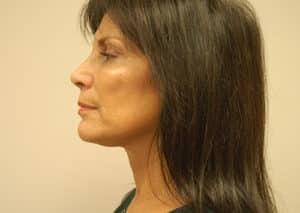 John F. Farella, MD, FACS facelift after — White Plains, NY