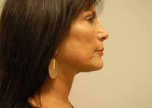 John F. Farella, MD, FACS facelift after — White Plains, NY