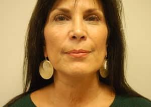 John F. Farella, MD, FACS facelift after — White Plains, NY
