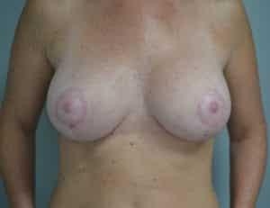 John F. Farella, MD, FACS breast lift after — White Plains, NY