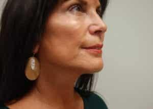John F. Farella, MD, FACS facelift after — White Plains, NY