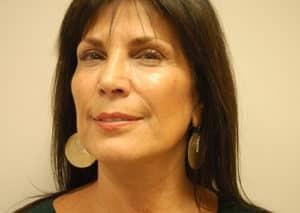 John F. Farella, MD, FACS facelift after — White Plains, NY